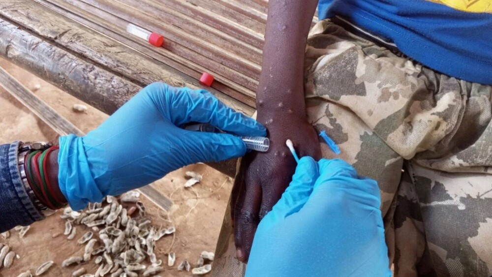 Alerta mundial por viruela del mono: ¿existen casos en el país? síntomas y tratamiento - Paraguay.com - Noticias de Paraguay en tiempo real. Paraguay en Internet.